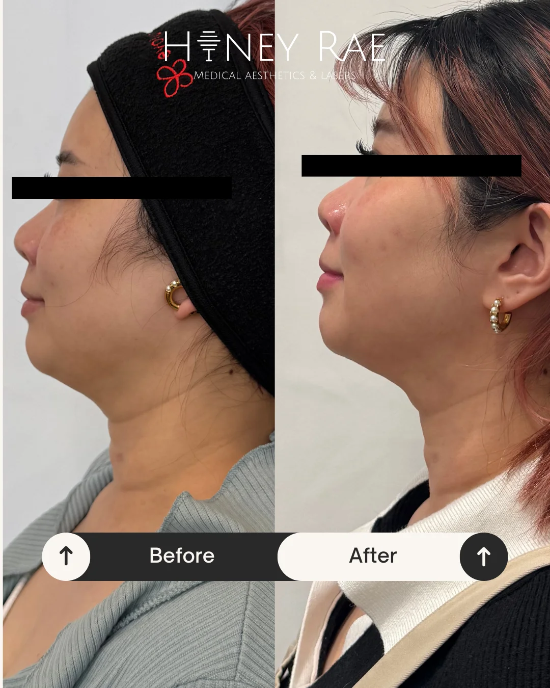 Morpheus8 Full Face before and after results at Honey Rae Aesthetics Eagle Mountain Utah