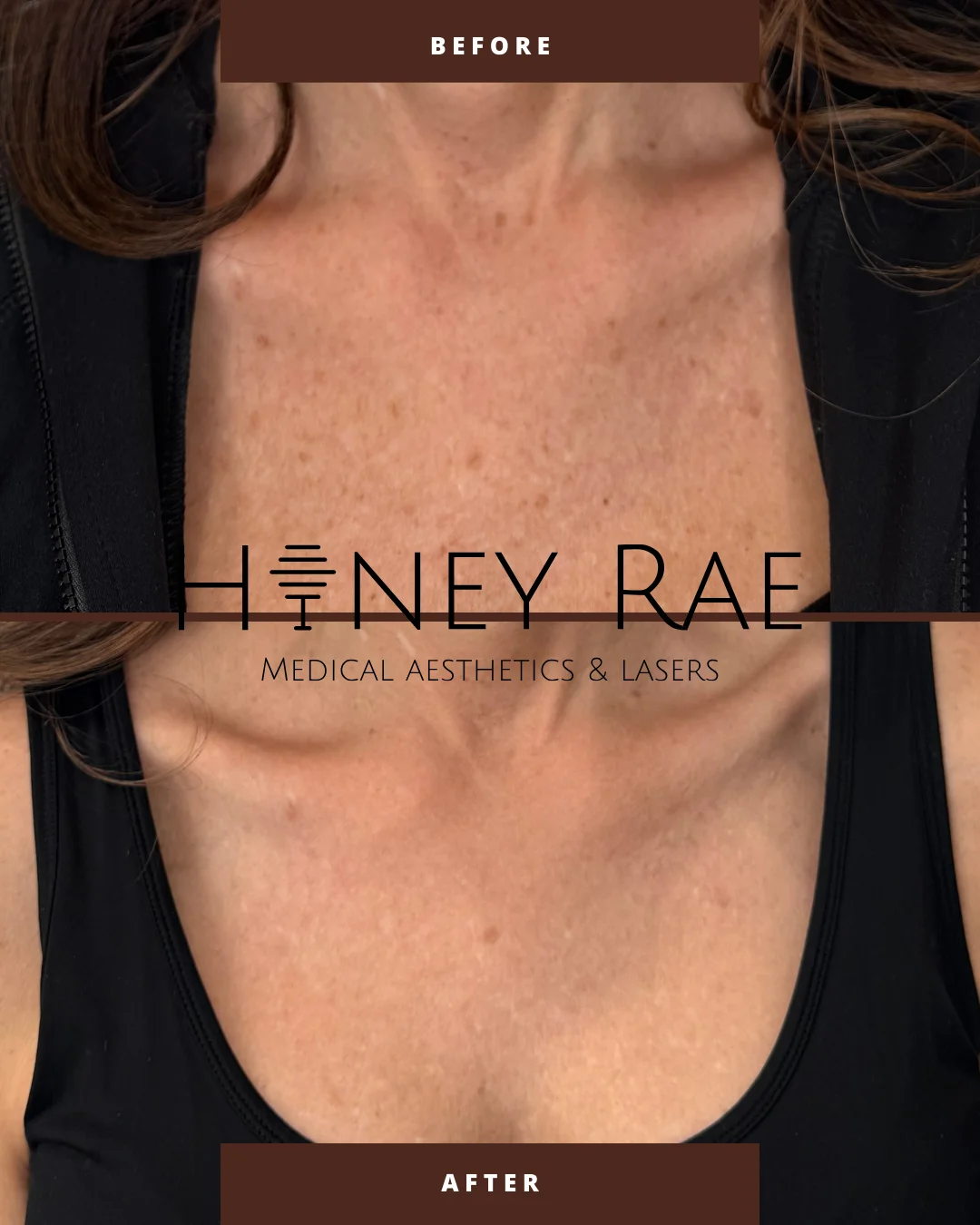 IPL Photofacial before and after results at Honey Rae Aesthetics Eagle Mountain Utah