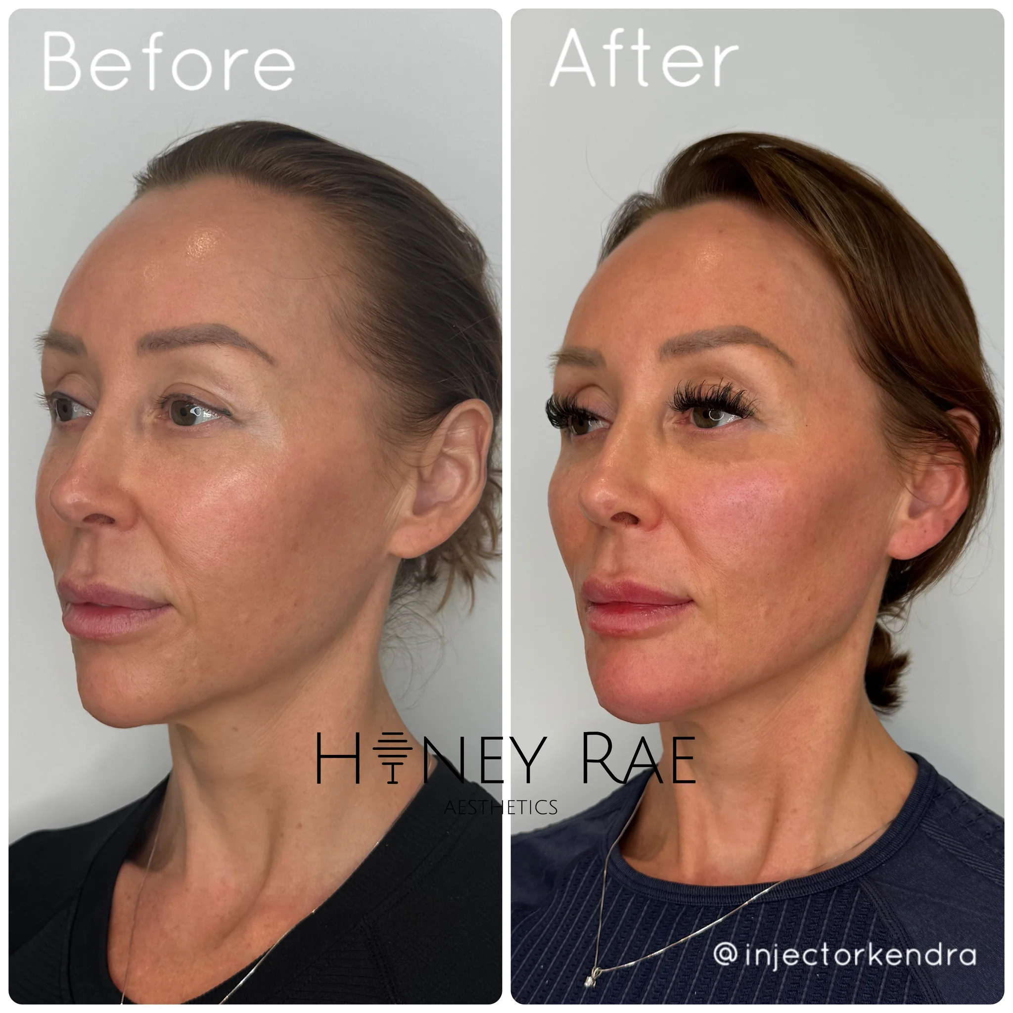 Morpheus8 + IPL Combination before and after results at Honey Rae Aesthetics Eagle Mountain Utah