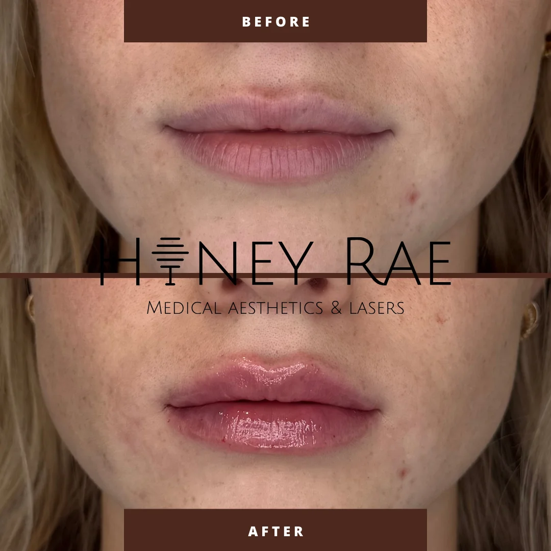 Lip Enhancement before and after results at Honey Rae Aesthetics Eagle Mountain Utah