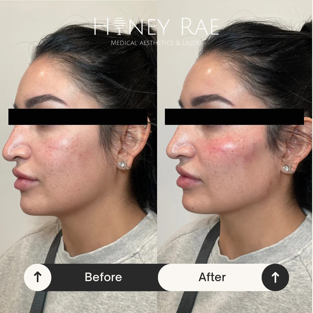 Cheek Filler Contouring before and after results at Honey Rae Aesthetics Eagle Mountain Utah