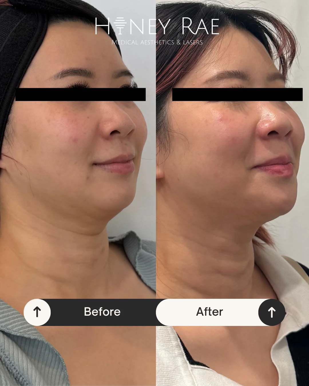 Before and after treatment results at Honey Rae Aesthetics