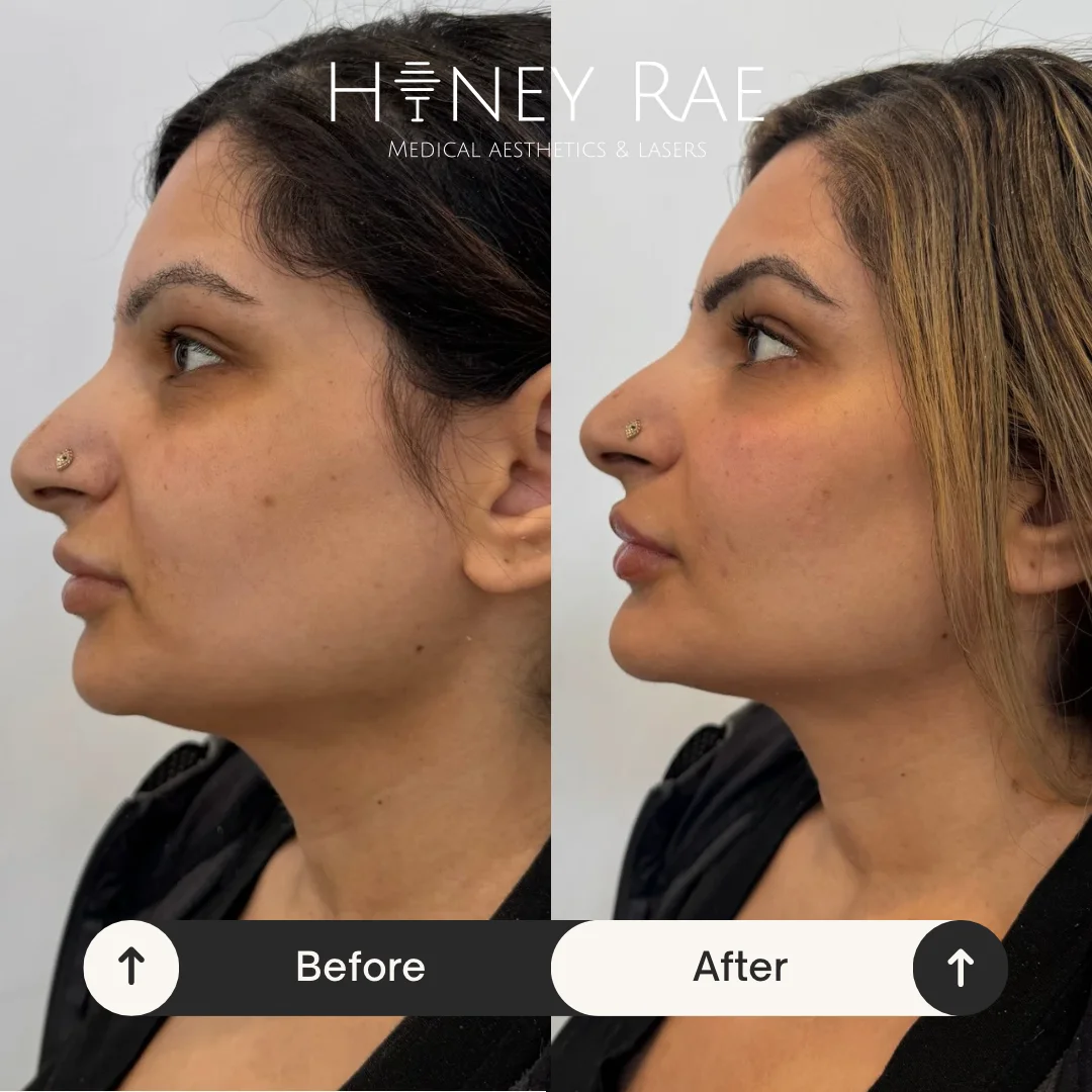 Morpheus8 Texture Refinement before and after results at Honey Rae Aesthetics Eagle Mountain Utah