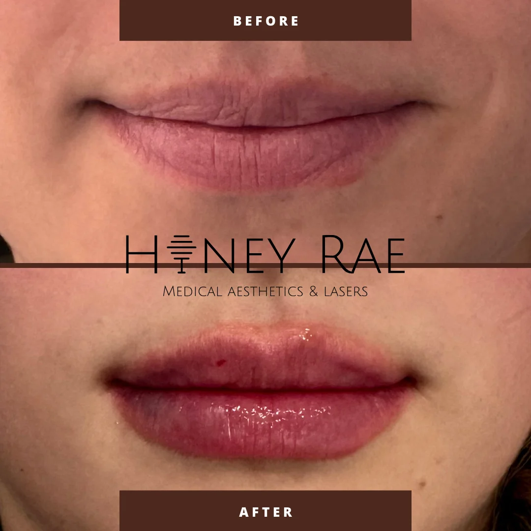 Lip Correction before and after results at Honey Rae Aesthetics Eagle Mountain Utah