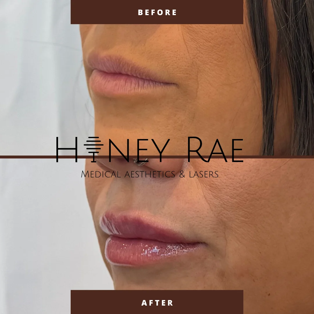 Lip Correction Care before and after results at Honey Rae Aesthetics Eagle Mountain Utah
