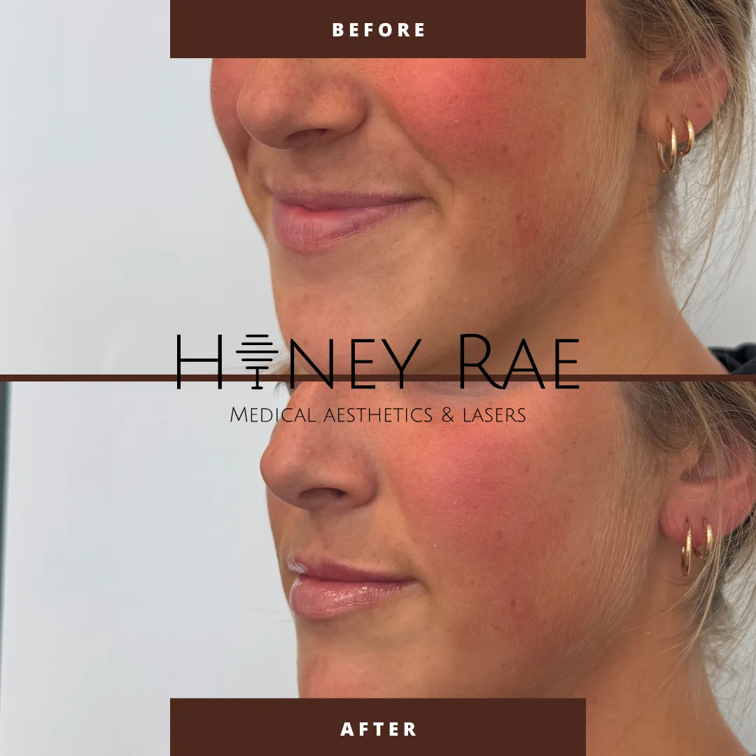 Lip Volume Enhancement before and after results at Honey Rae Aesthetics Eagle Mountain Utah
