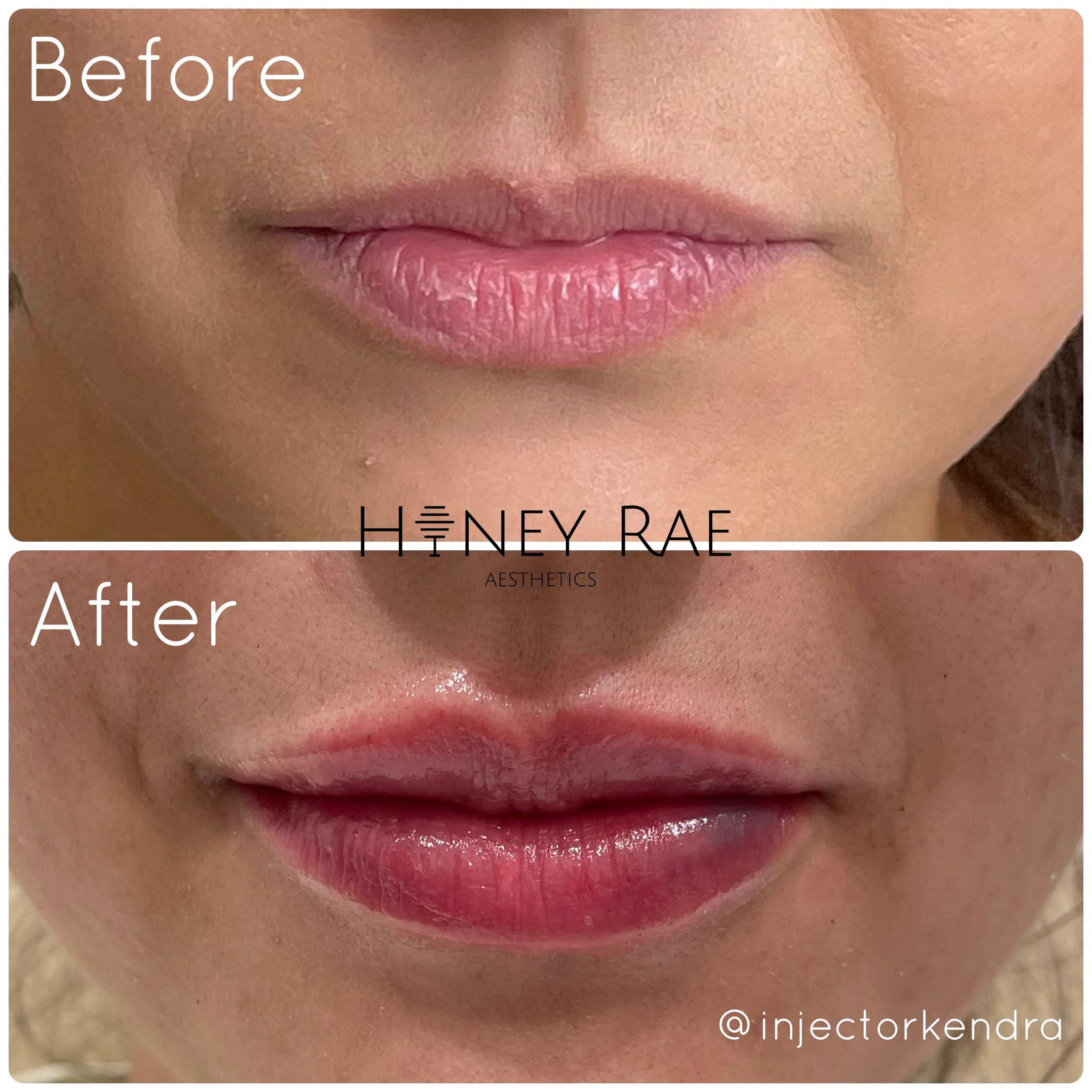 Lip Definition before and after results at Honey Rae Aesthetics Eagle Mountain Utah