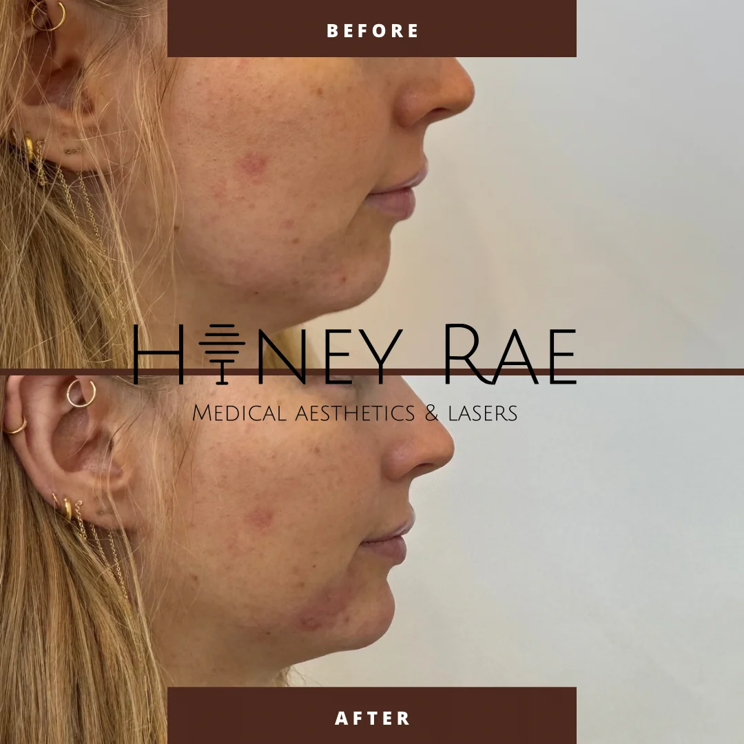 Chin Filler Sculpting before and after results at Honey Rae Aesthetics Eagle Mountain Utah
