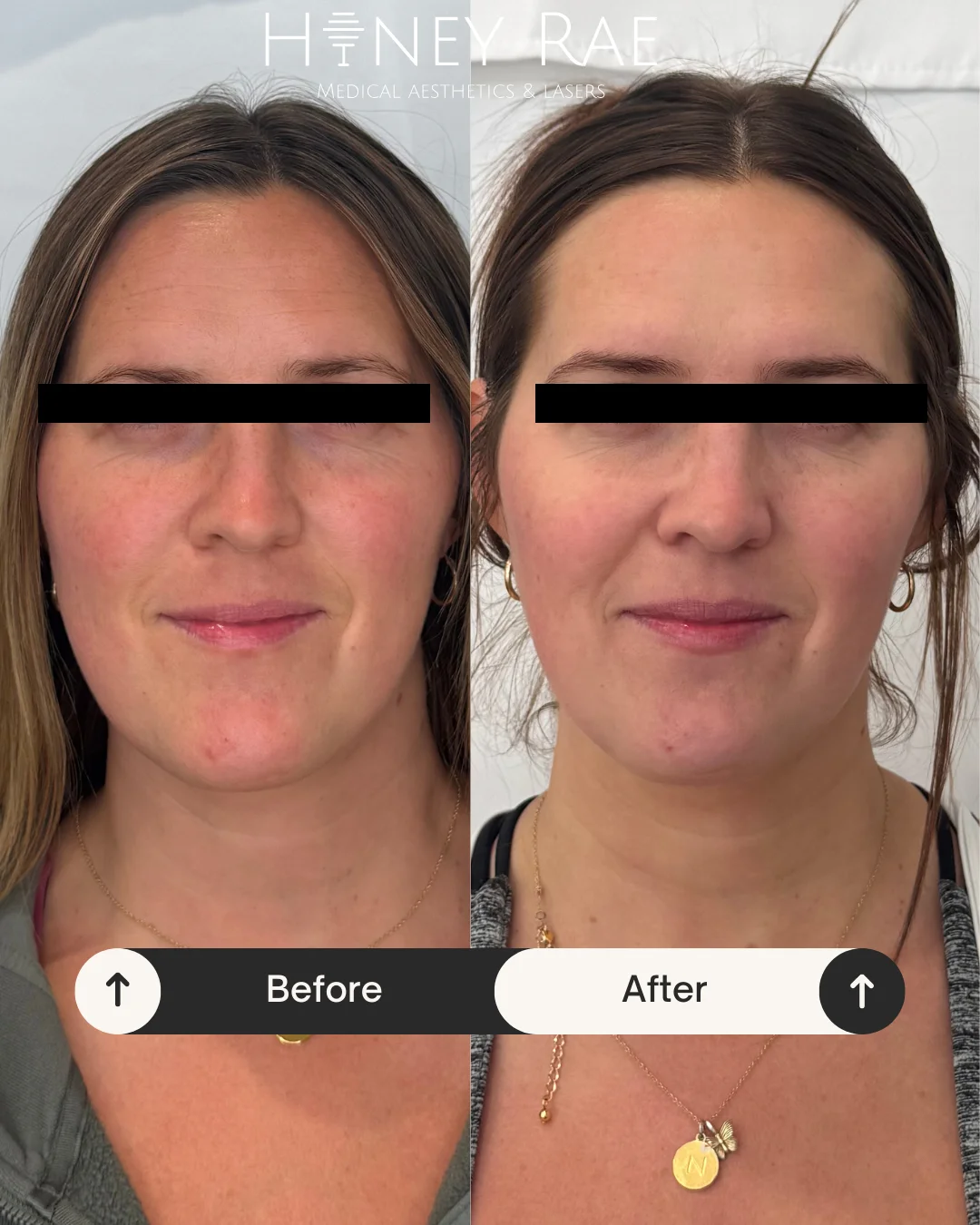 IPL Skin Correction before and after results at Honey Rae Aesthetics Eagle Mountain Utah