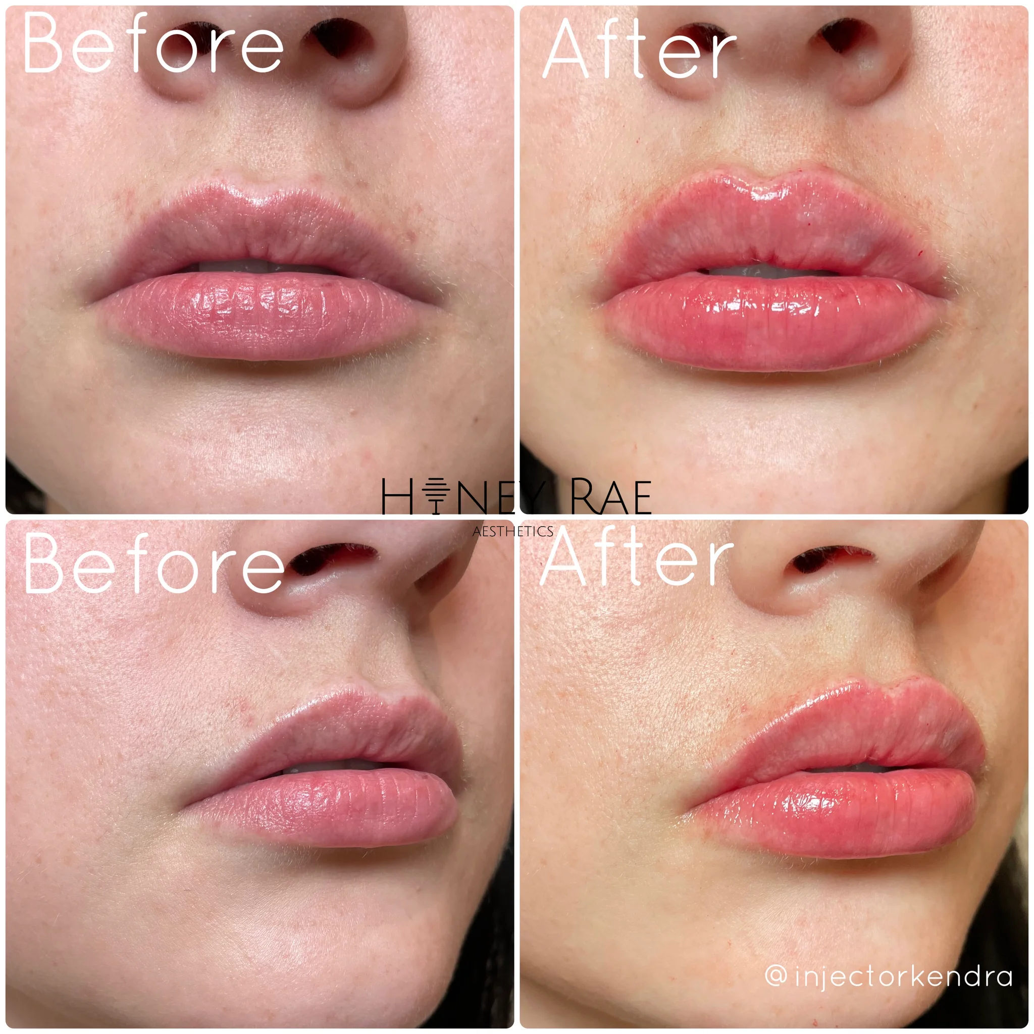 Lip Rejuvenation before and after results at Honey Rae Aesthetics Eagle Mountain Utah