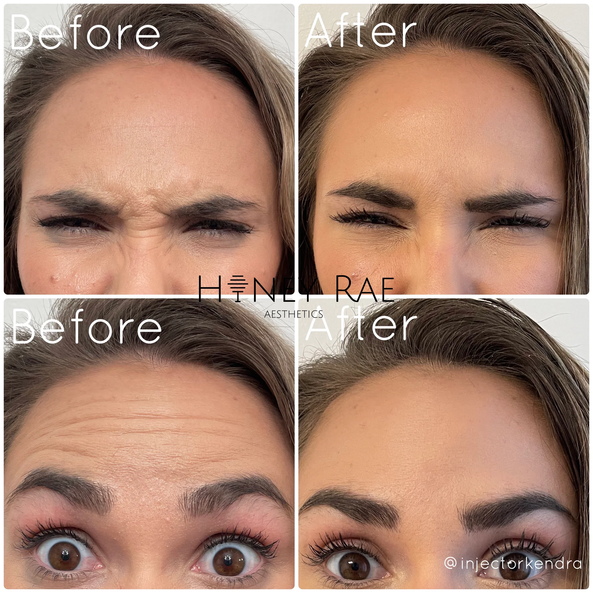 Neurotoxin Forehead Smoothing before and after results at Honey Rae Aesthetics Eagle Mountain Utah