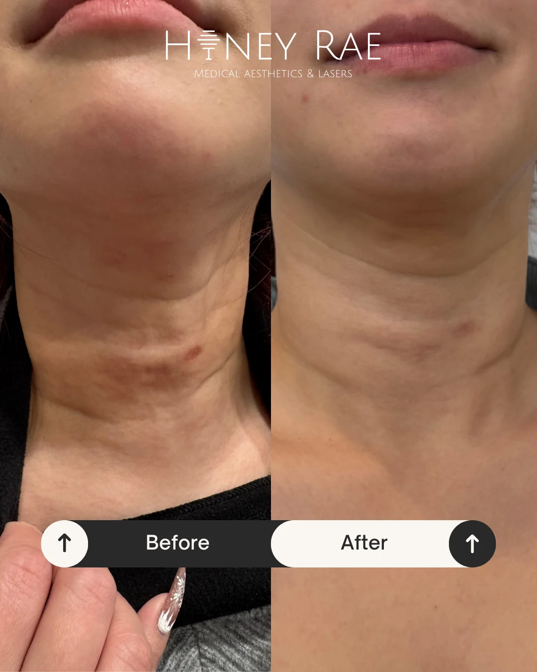 Morpheus8 Rejuvenation before and after results at Honey Rae Aesthetics Eagle Mountain Utah