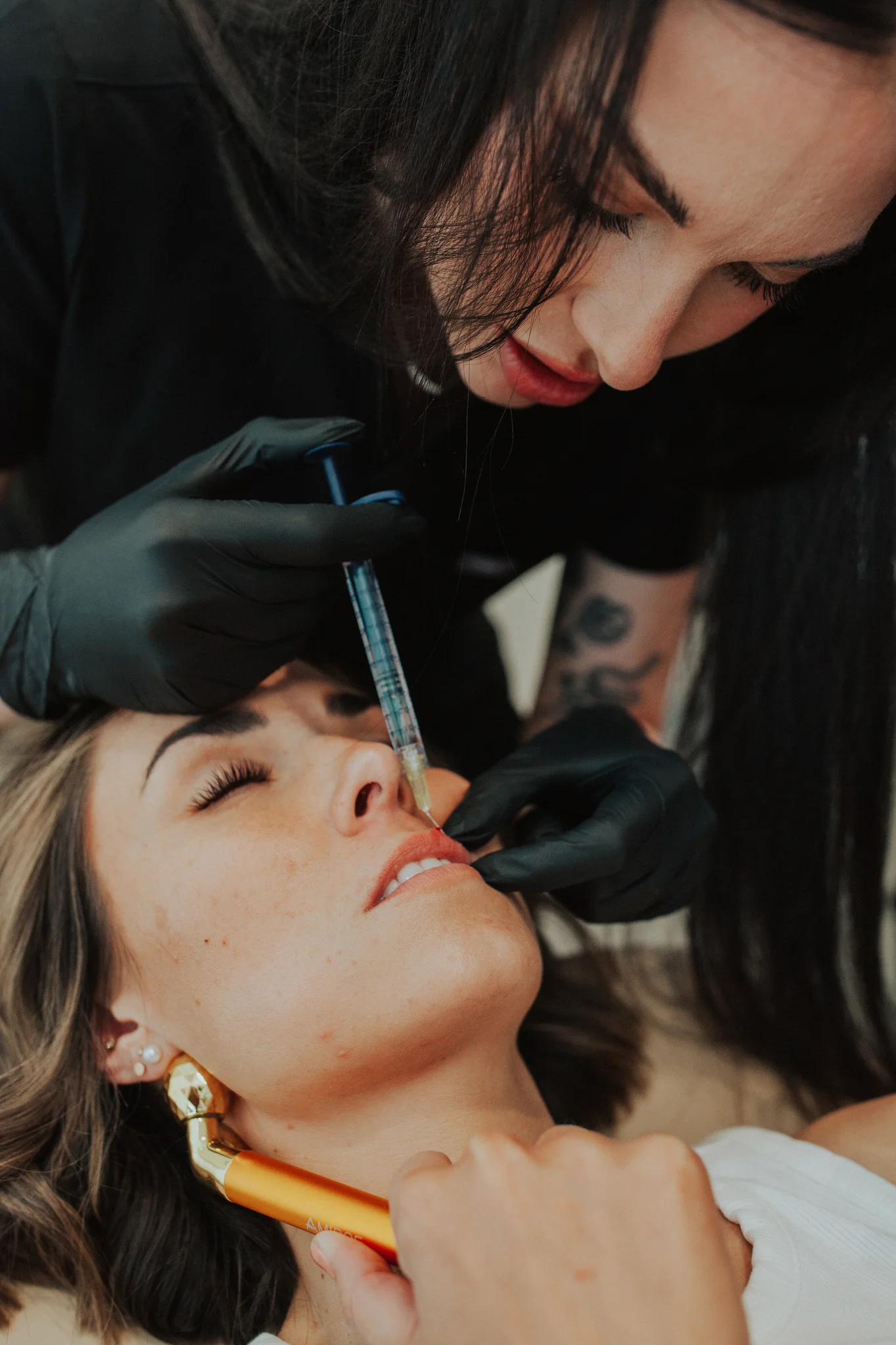 Dermal filler treatment