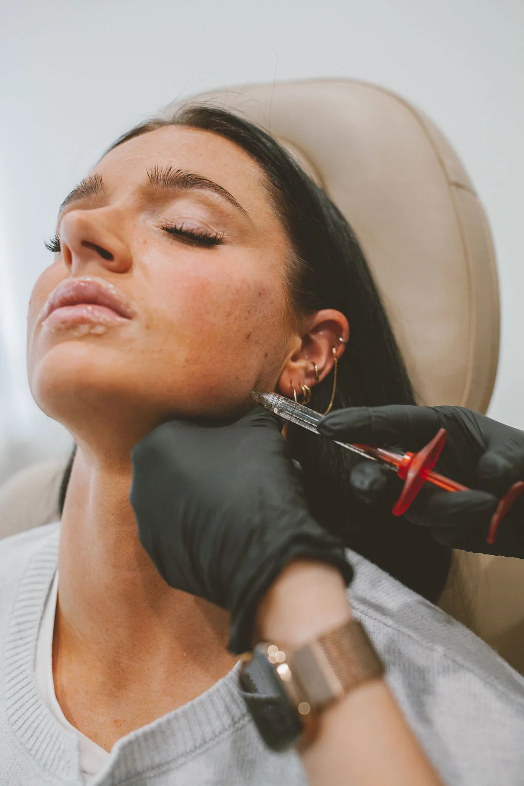 Dermal filler results