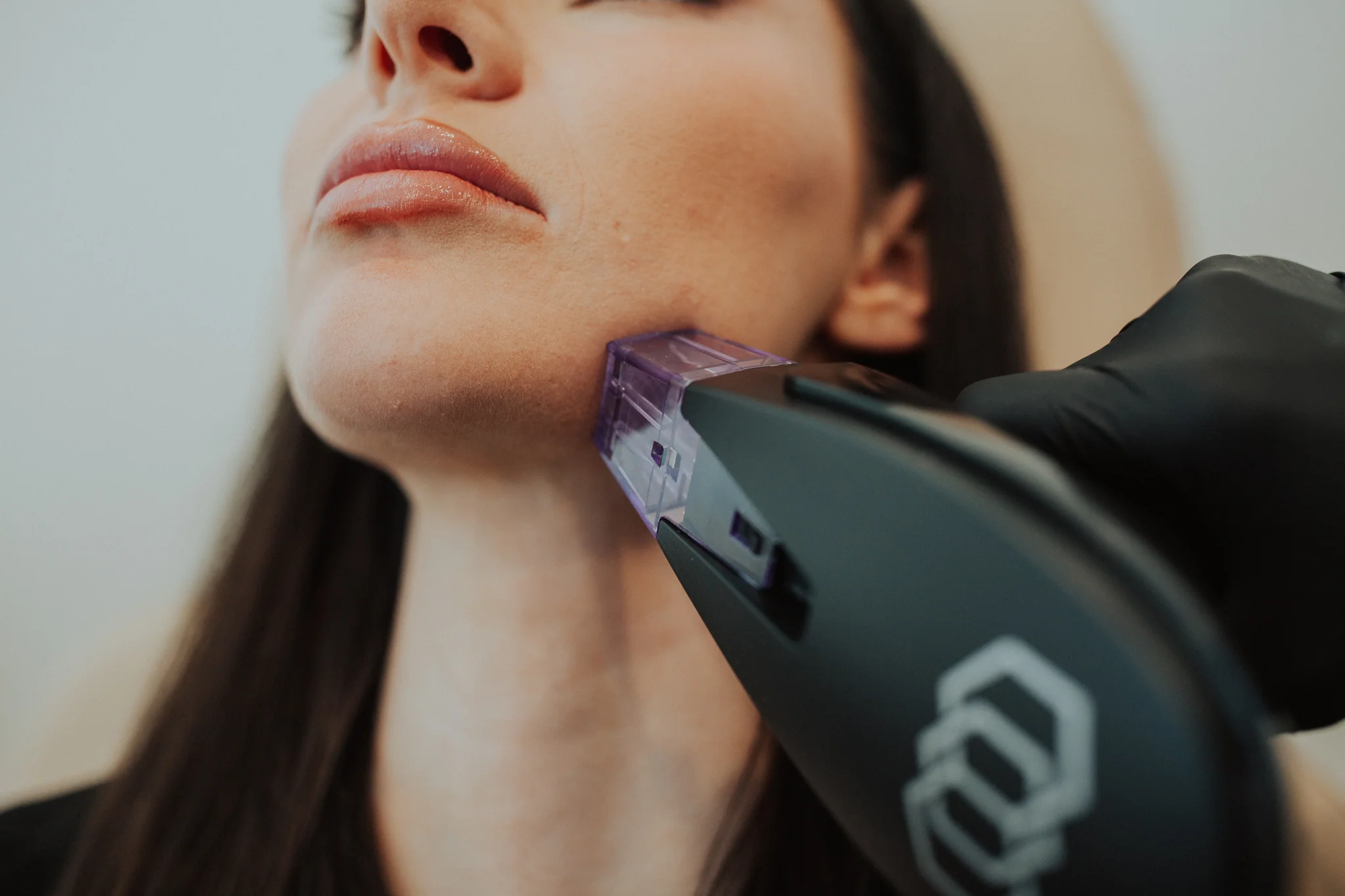 Morpheus8 skin tightening treatment