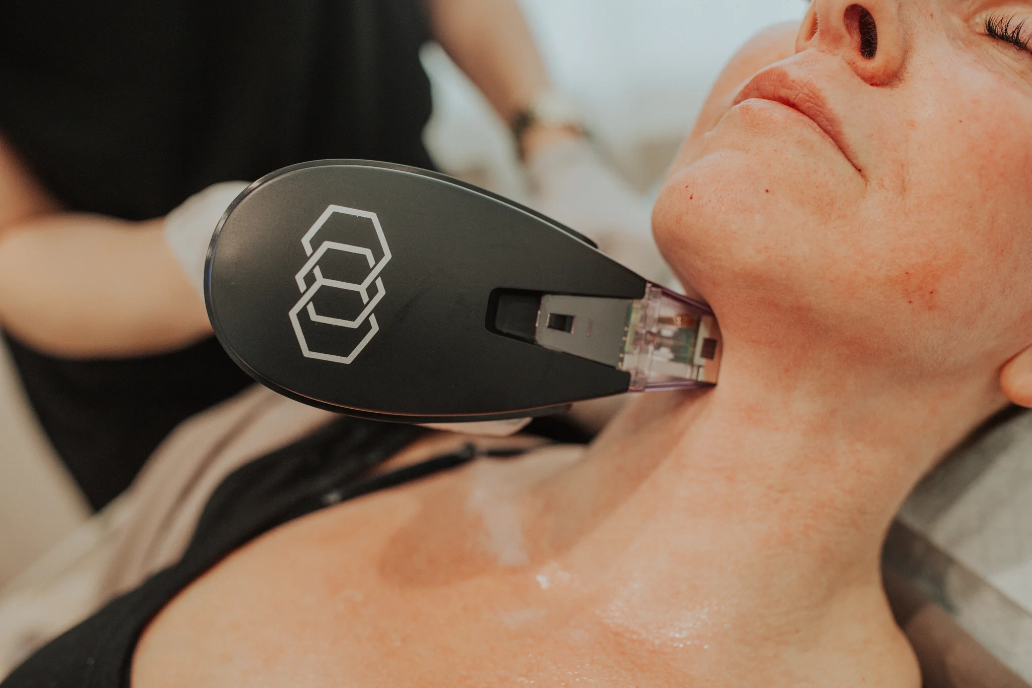 Morpheus8 radiofrequency microneedling