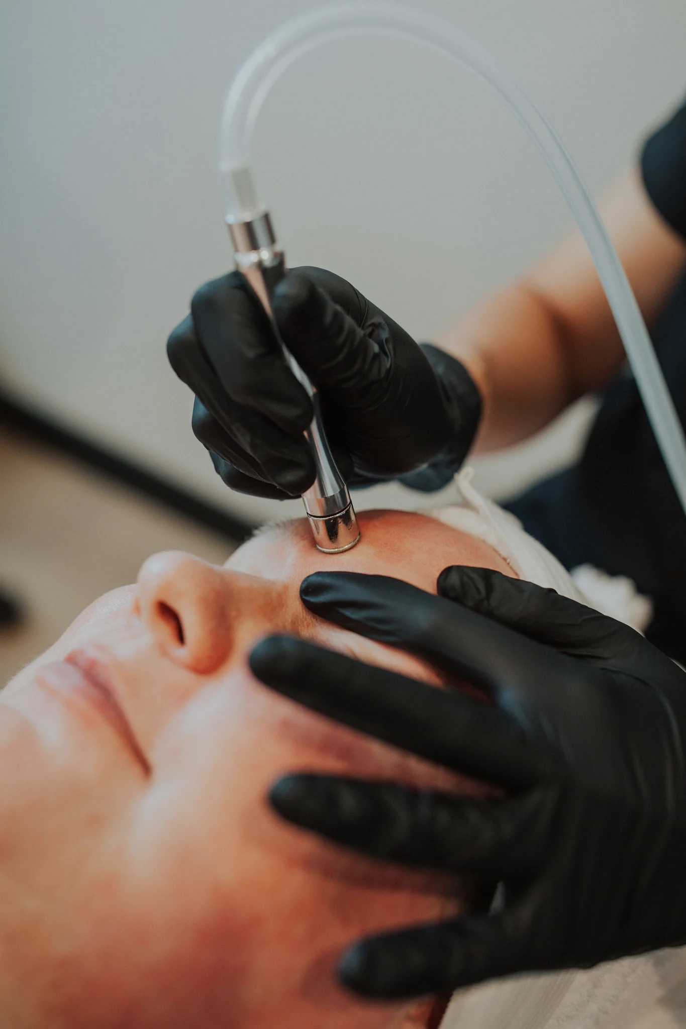 Neurotoxin Treatments results